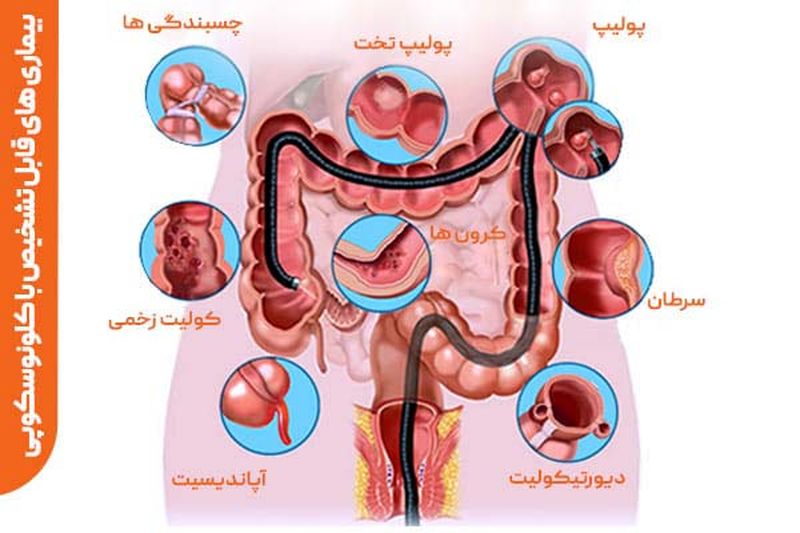 تشخیص بیماریها با کولونوسکوپی