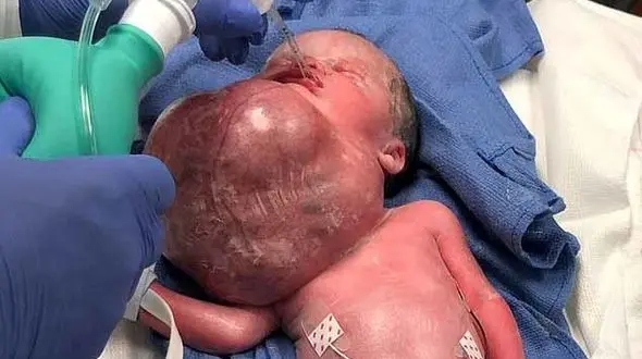 خارج کردن کیست حجیم از گردن یک نوزاد+عکس