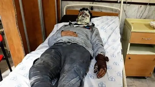 سوختگی شدید پسر تهرانی در شهر ری 