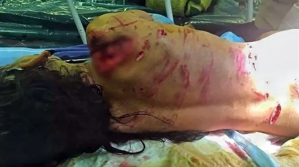 سرنوشت دختر 7 ساله گلفروش که مورد حمله سگ ها قرار گرفته بود + عکس