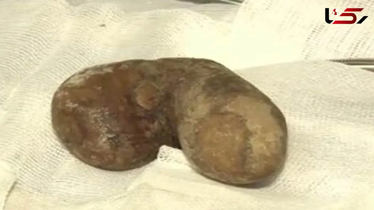 سنگ 14 سانتی‌متری از کلیه یک جوان در بندرعباس خارج شد + عکس