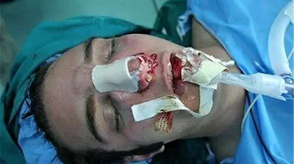 چرا زنان مرتب جراحی زیبایی  می‌کنند 