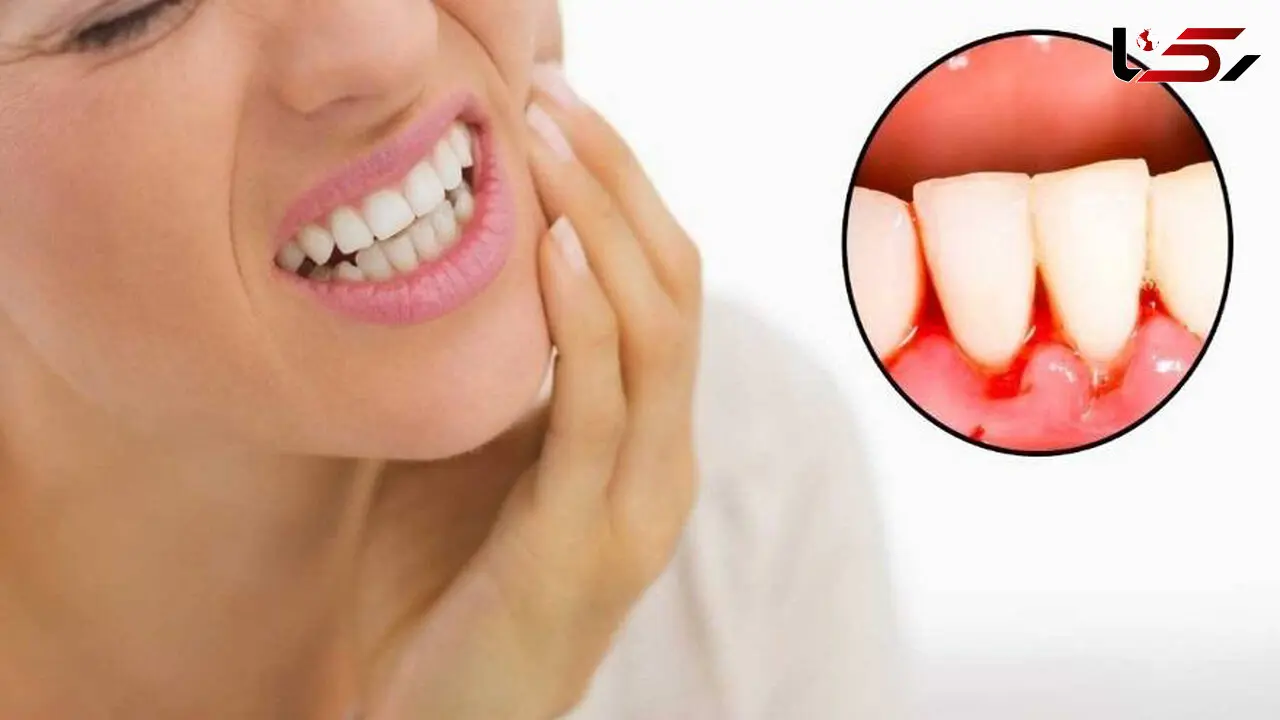 بیماری لثه ریسک ابتلا به سرطان در زنان را افزایش می دهد