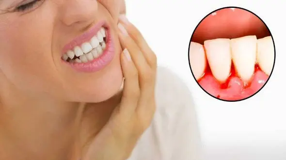 بیماری لثه ریسک ابتلا به سرطان در زنان را افزایش می دهد