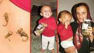 پدیده نادر پزشکی / کودک دهدشتی که بدنش عقرب تولید می کند ! + عکس