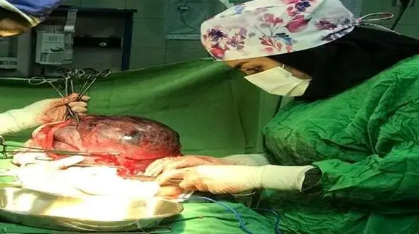 خارج کردن توده ۵ کیلویی از شکم مادر باردار گیلانی
