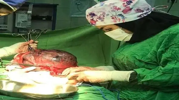 خارج کردن توده ۵ کیلویی از شکم مادر باردار گیلانی