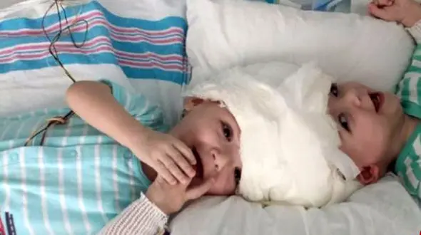 جداسازی موفقیت آمیز دوقلوهای 13 ماهه به هم چسبیده +تصاویر 