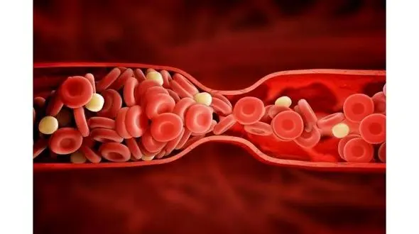 ارتباط میزان پایین آهن و ریسک بیماری قلبی
