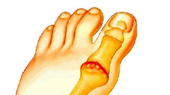 درمان التهاب مفصل انگشت پا با این راهکارها