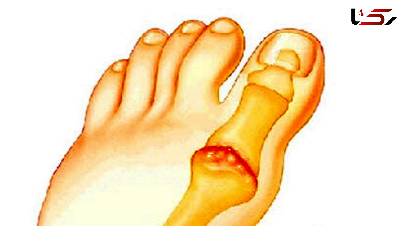 درمان التهاب مفصل انگشت پا با این راهکارها