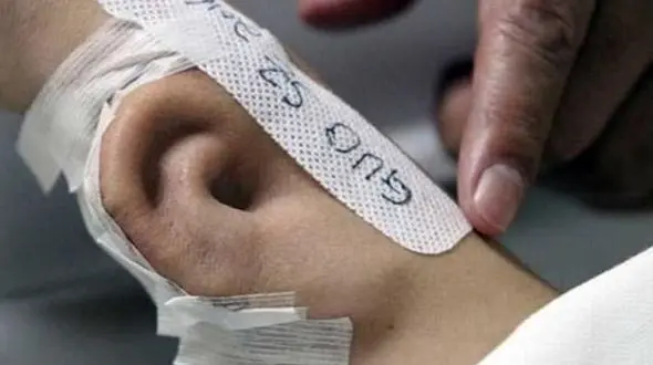 کاشت گوش مصنوعی روی بازوی بیمار!