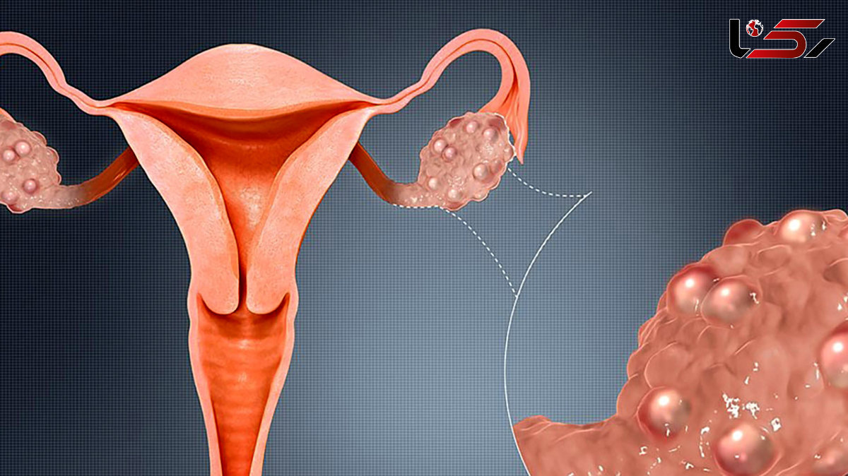 تنبلی تخمدان از علت و نشانه ها تا درمان 