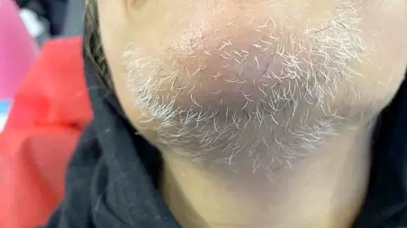 از بین بردن موهای زاید سفید صورت با 9 روش طبیعی و موثر