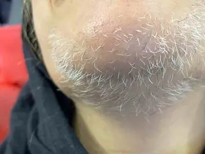 از بین بردن موهای زاید سفید صورت با 9 روش طبیعی و موثر