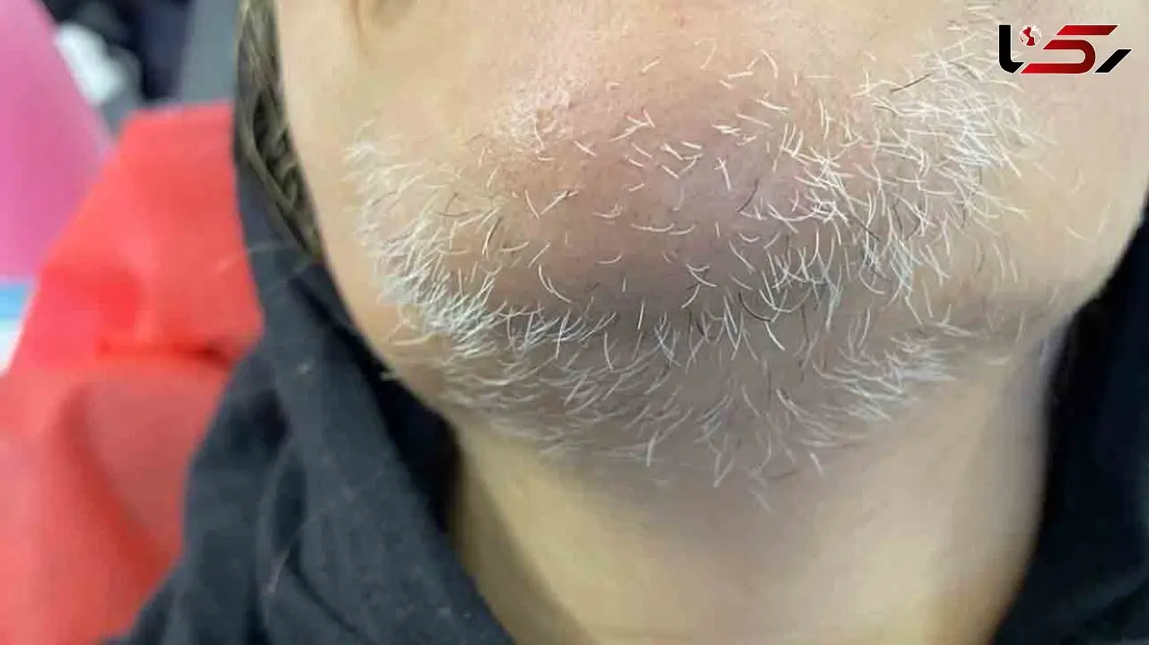 از بین بردن موهای زاید سفید صورت با 9 روش طبیعی و موثر