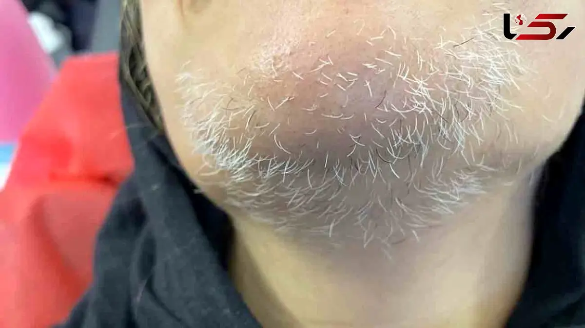 از بین بردن موهای زاید سفید صورت با 9 روش طبیعی و موثر