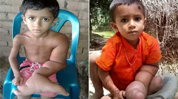 دست این پسر بچه شبیه پای گنده است!+تصاویر عجیب