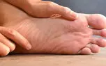 سوزش کف پا نشانه چیست؟ / درمان سنتی + 4 جدول 