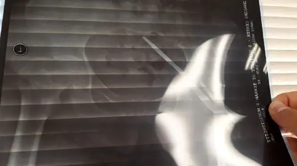 وقتی پیچ 7 سانتی در بدن بیمار جا ماند! + عکس  جالب