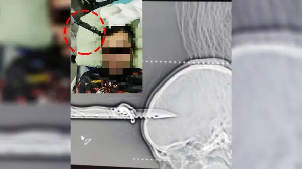 عکس شوک آور از چاقو در جمجمه جوان ورامینی