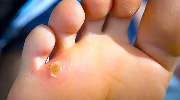 درمان های طبیعی و پزشکی میخچه پا 