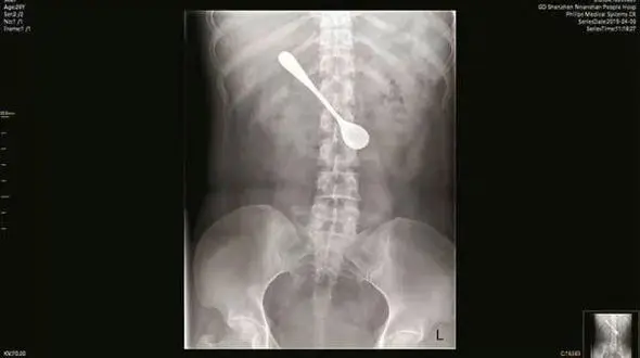 عکس / قاشق 13 سانتی در معده یک زن !