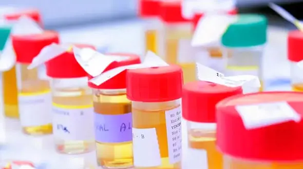 specific gravity چیست؟ / کاربرد Specific Gravity در آزمایش ادرار