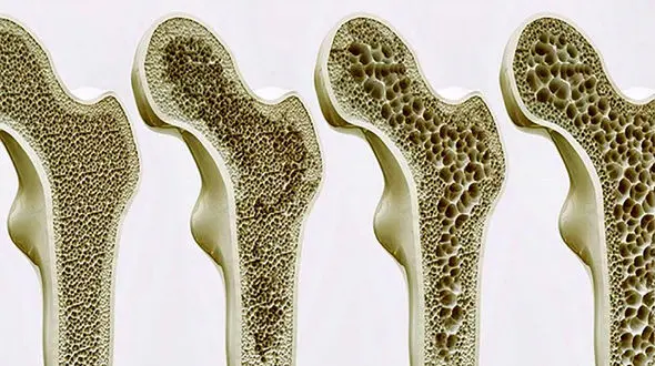 غربالگری رایگان پوکی استخوان 
