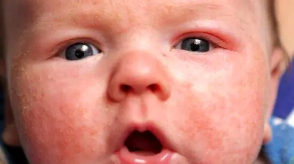 سرخک را در نوزادان جدی بگیرید