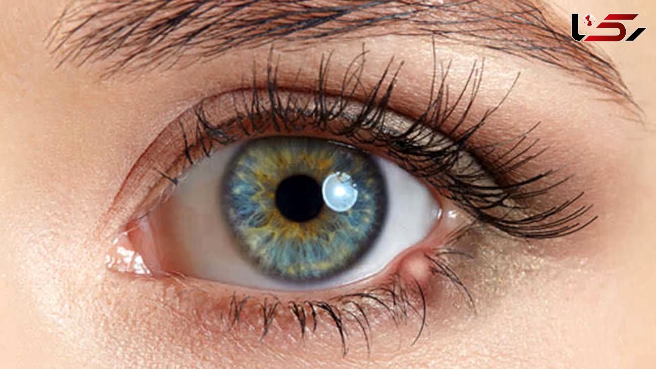 دلایل ایجاد گل مژه در چشم + درمان 