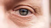 رفع چروک دور چشم با ویتامین E؛ آیا این روش خانگی مؤثر است؟