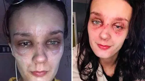 بلایی که تخم مرغ آب پز بر سر دختر 19 ساله آورد + عکس 