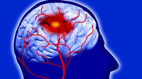 استرس زیاد؛ عامل اصلی سکته مغزی و فجایع ناگهانی!