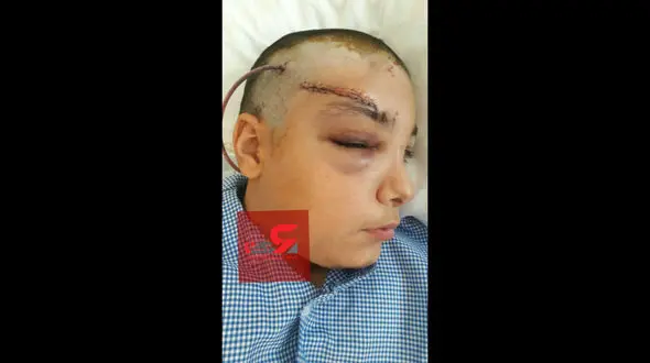 سقوط پنکه سقفی کلاس دانش آموز یزدی را به شدت مجروح کرد + عکس