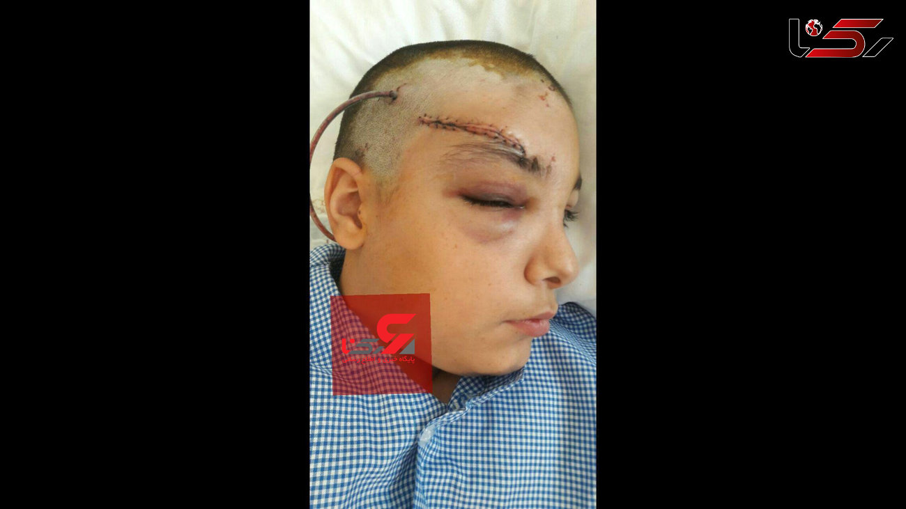 سقوط پنکه سقفی کلاس دانش آموز یزدی را به شدت مجروح کرد + عکس