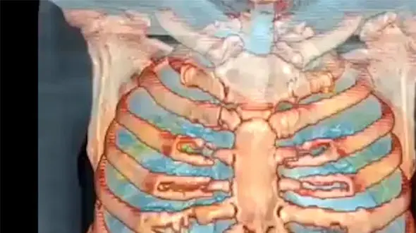 فیلم / ببینید کرونا با ریه  چه کار می کند؟