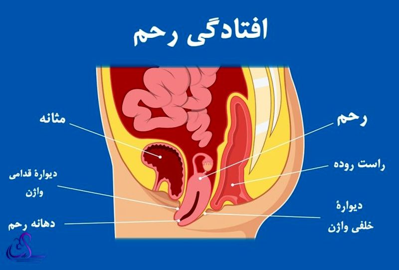 درمان واژینیسموس افتادگی رحم