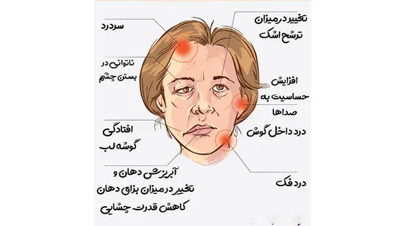 فلج بل چیست؟