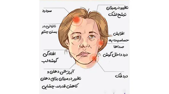 فلج بل چیست؟