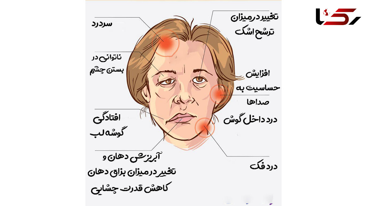 فلج بل چیست؟