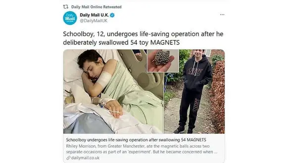 بلعیدن 54 گوی آهن ربایی توسط پسر 12 ساله ! + عکس