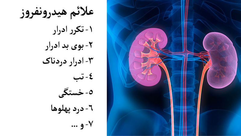 علائم هیدرونفروز