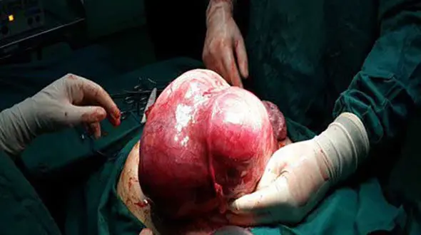 جا خوش کردن توده 4 کیلویی در بدن زن  قزوینی + عکس 