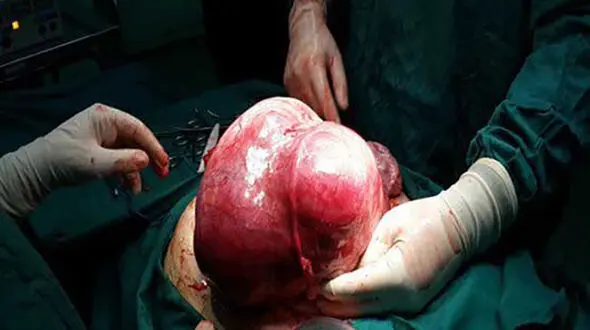 جا خوش کردن توده 4 کیلویی در بدن زن  قزوینی + عکس 