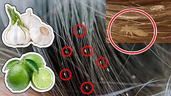 چگونه شپش سر را ریشه کن کنیم؟