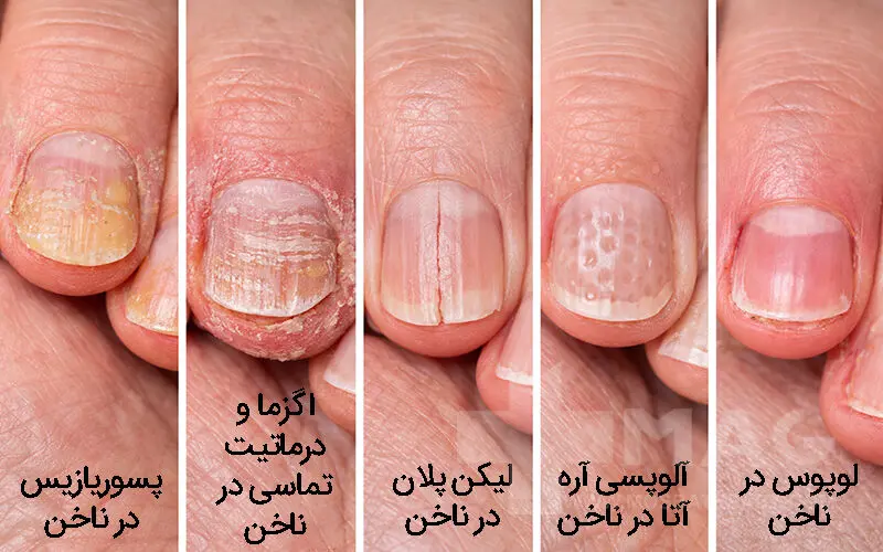 بیماری های ناخن (التهابی و خود ایمنی)
