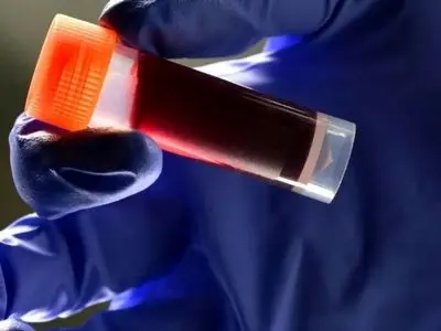 این گروه خونی بیشترین احتمال سکته مغزی را دارد!