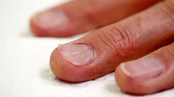 علائم کمبود ویتامین و مواد مغدی در ناخن ها