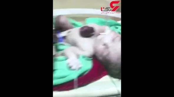 تولد نوزاد عجیب الخلقه هندی که قلبش خارج از بدنش می‌تپد+ فیلم و عکس